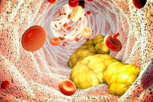 How to Lower Cholesterol Naturally?