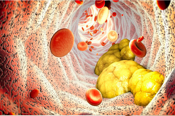 How to Lower Cholesterol Naturally?